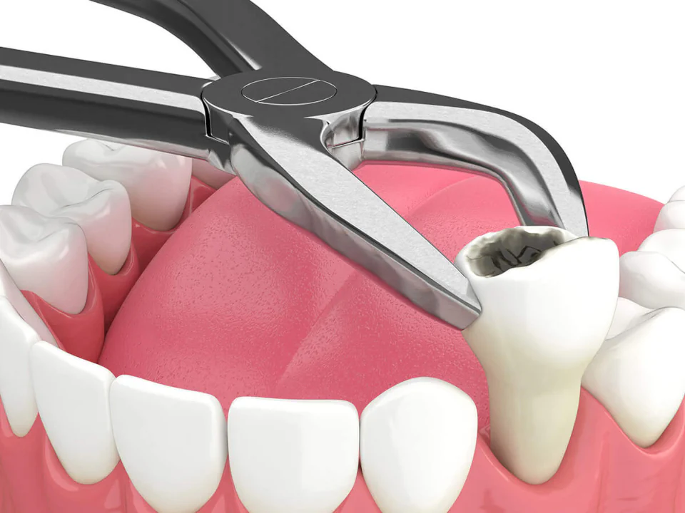 Tooth extractions in Tomball, TX at Willow Creek Smiles.