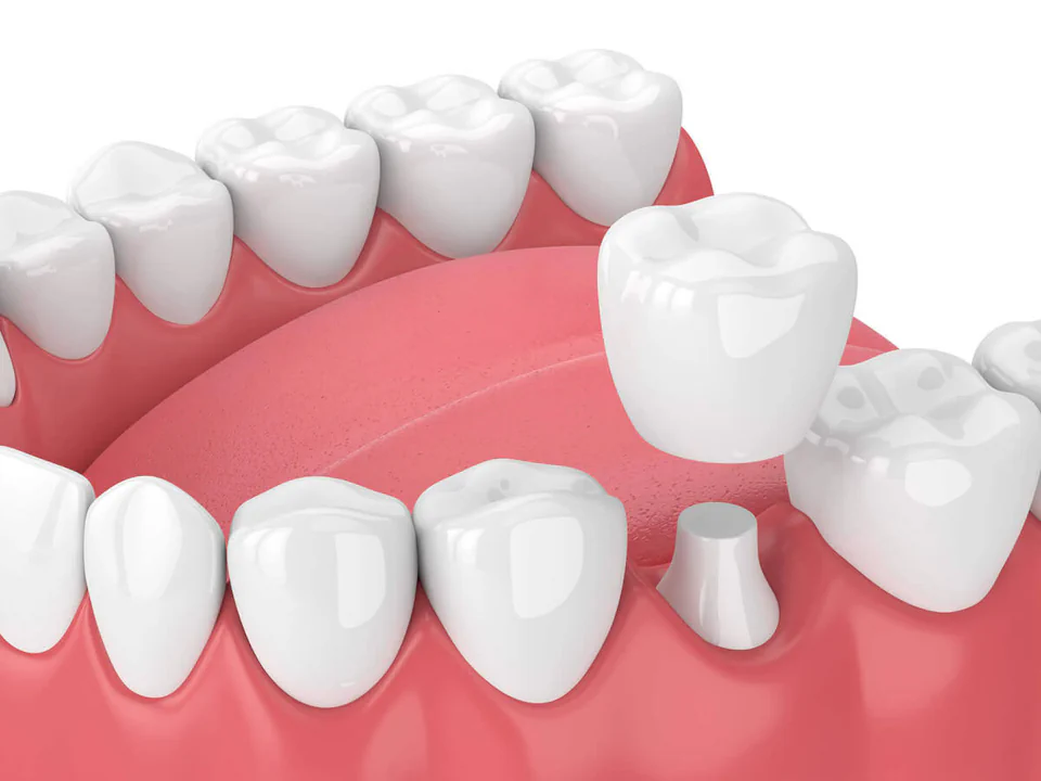 Dental crowns and bridges in Tomball, TX at Willow Creek Smiles.