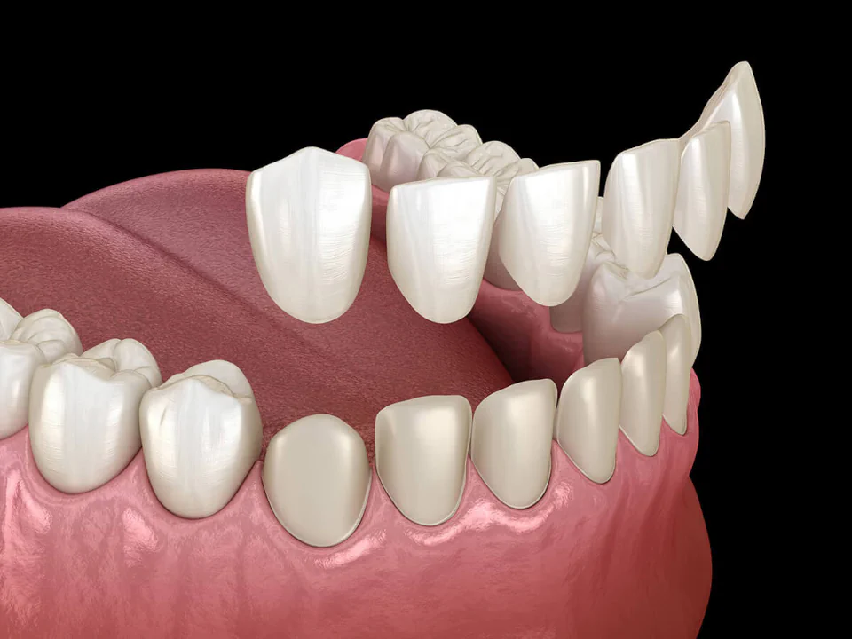Dental veneers in Tomball, TX at Willow Creek Smiles.