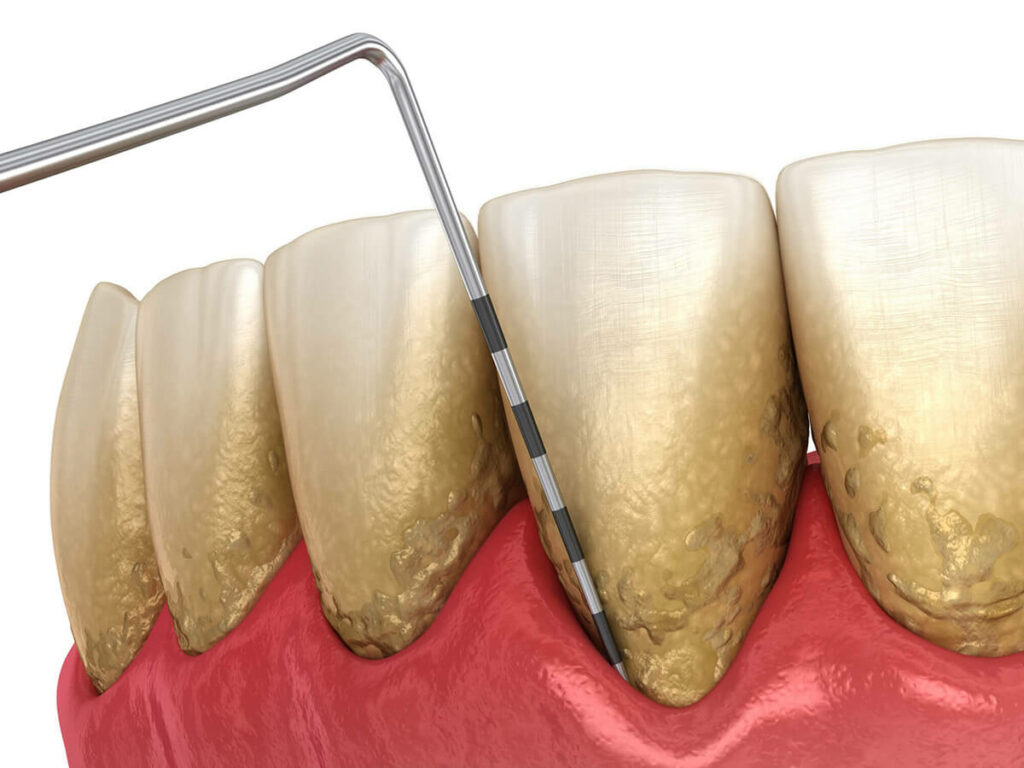 periodontal disease treatment