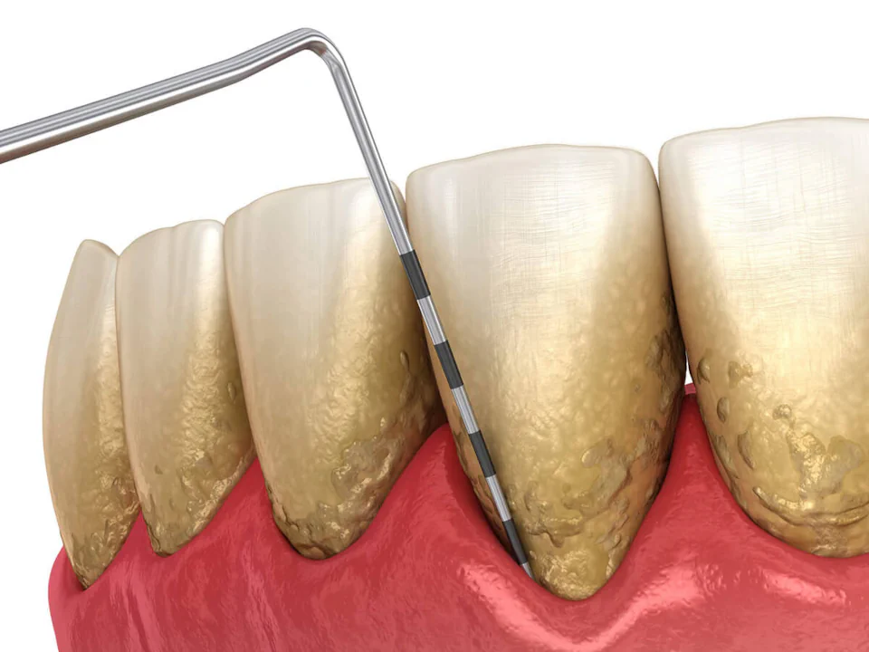 Gum disease treatment in Tomball, TX at Willow Creek Smiles.
