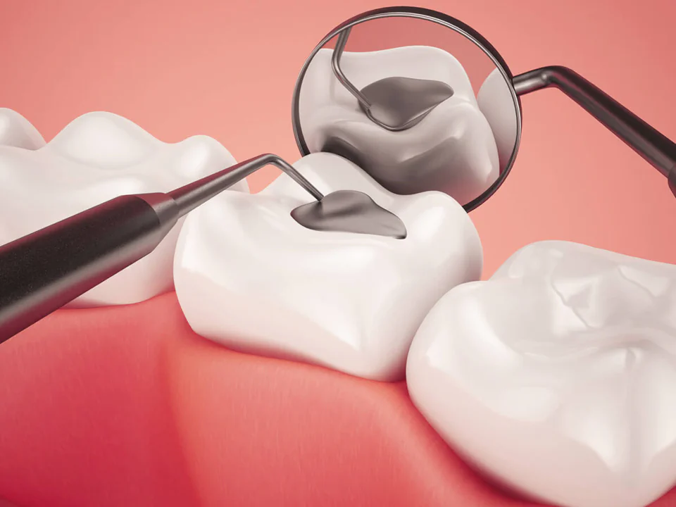 Dental fillings and sealants in Tomball, TX at Willow Creek Smiles.